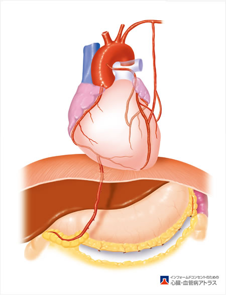 図：冠動脈バイパス手術
